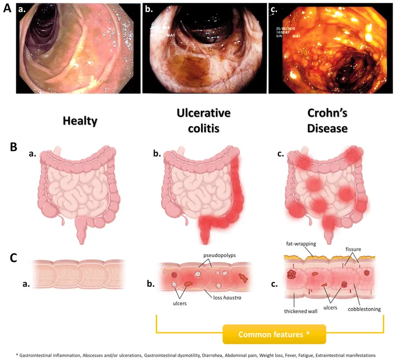 Crohn's vs Ulcerative Colitis: Location and Depth