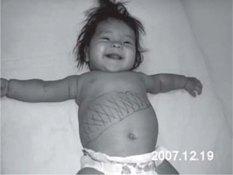 Infant with Von Gierke disease