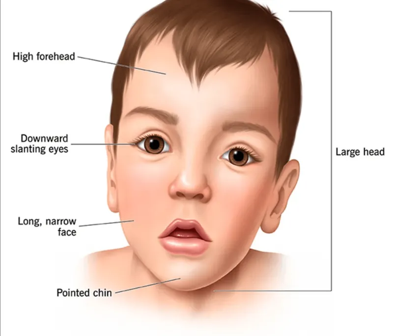 Dysmorphic features in genetic disorders