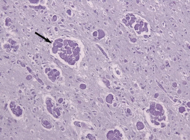 Tay-Sachs: Onion skin lysosomes in neurons