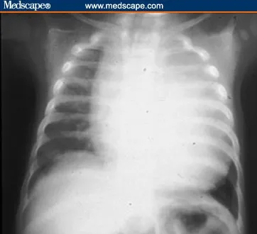 Cardiomegaly on chest X-ray in Pompe disease
