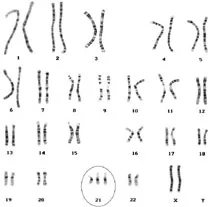 Karyotype of Trisomy 21 (Down Syndrome)
