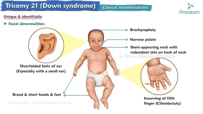 Down Syndrome: Clinical Manifestations in Infants