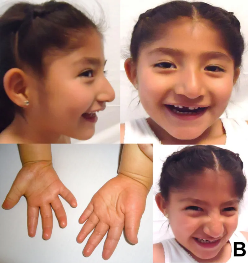 Angelman syndrome: facial features and hands