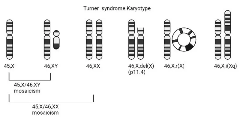 Turner Syndrome Karyotypes and Mosaicism