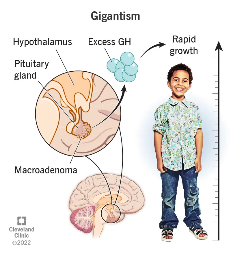 Gigantism: Excess GH from macroadenoma causes rapid growth