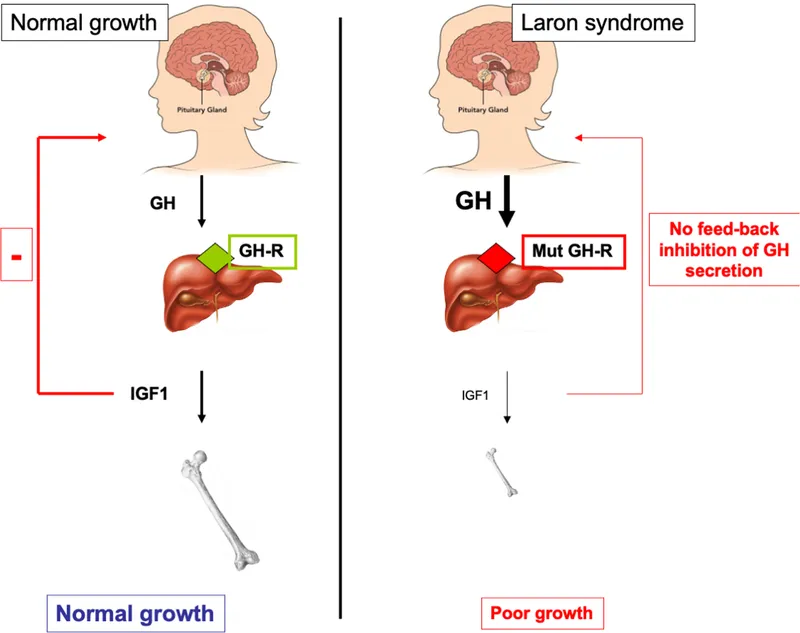 Normal vs. Laron syndrome GH signaling and growth
