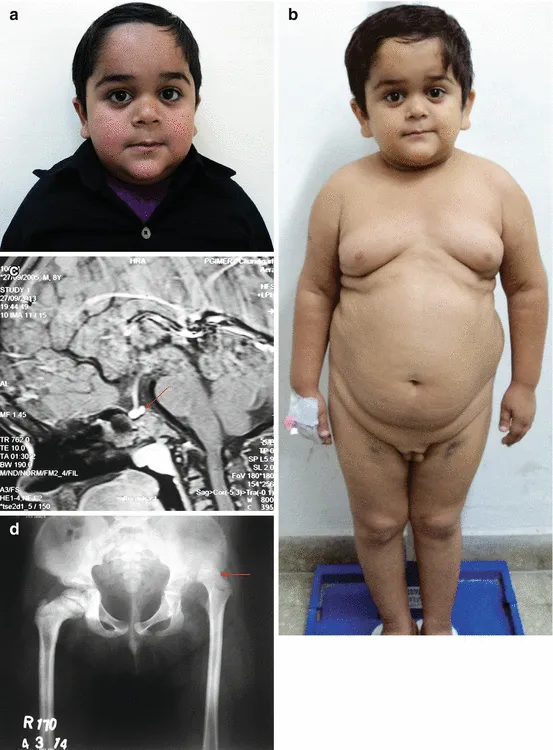 Child with GHD: cherubic facies, truncal obesity, MRI, X-ray