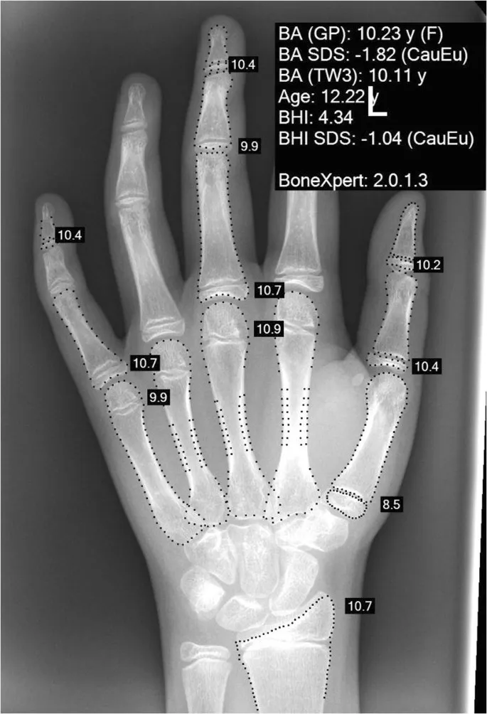 Left hand X-ray for bone age assessment
