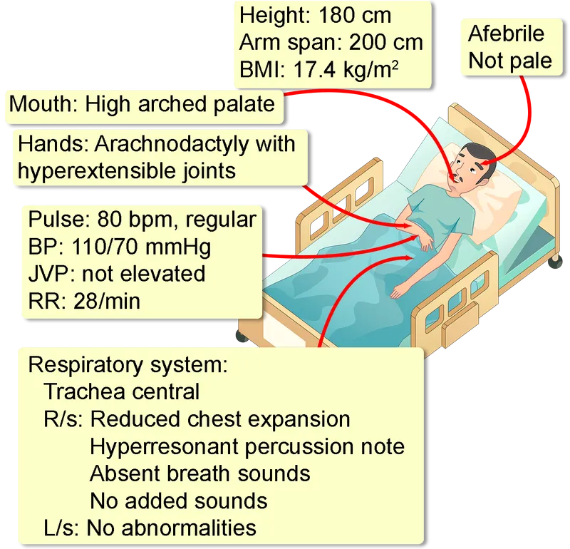 Clinical features of Marfan syndrome