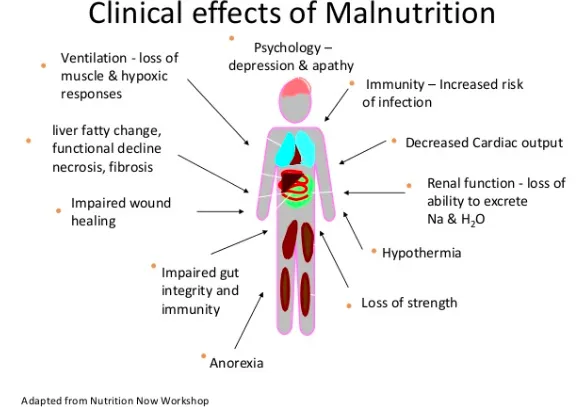 Clinical effects of malnutrition