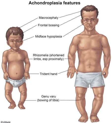 Achondroplasia features