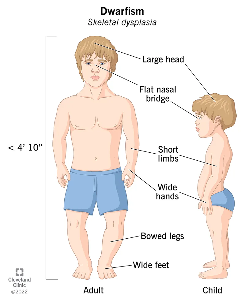 Dwarfism (Skeletal Dysplasia) Characteristics