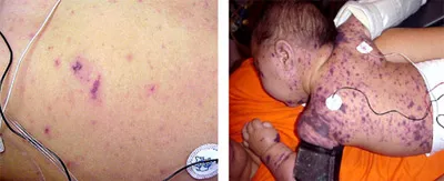 Petechiae, purpura, and ecchymoses on pediatric skin