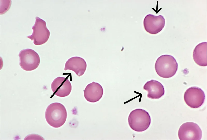 Bite and blister cells in hemolytic anemia