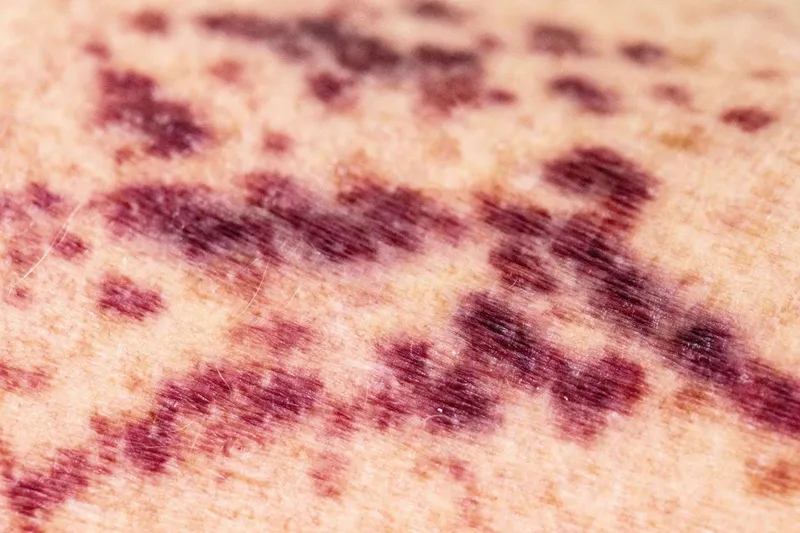 Petechiae and purpura on skin due to thrombocytopenia