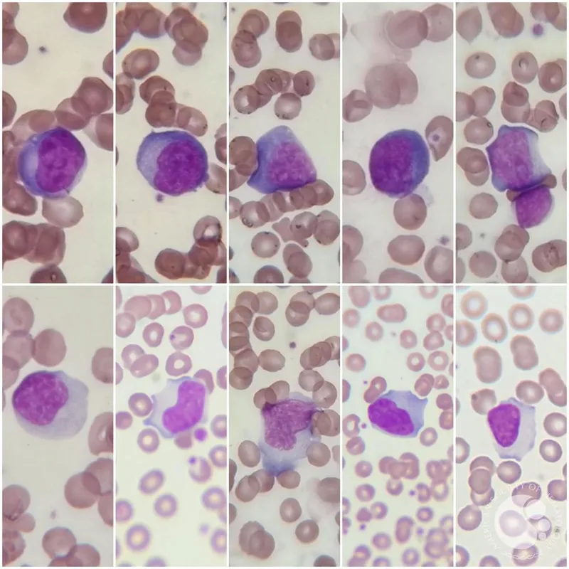 Atypical lymphocytes (Downey cells) in peripheral smear