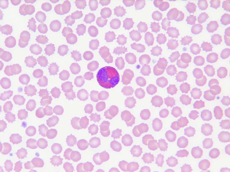Peripheral blood smear with eosinophilia