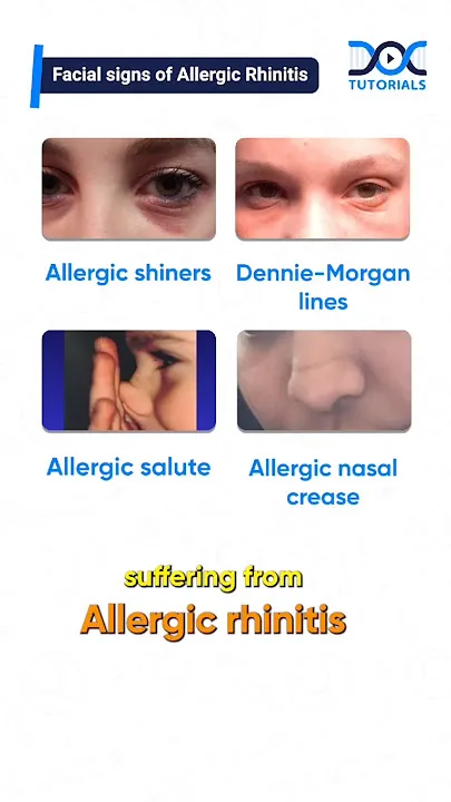Facial signs of Allergic Rhinitis