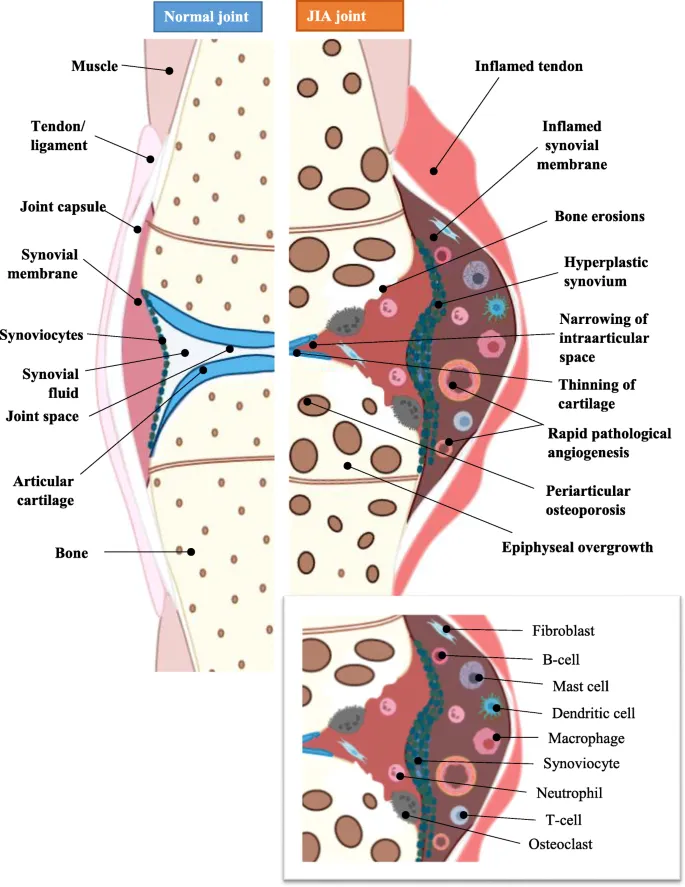 Normal vs JIA Joint Anatomy