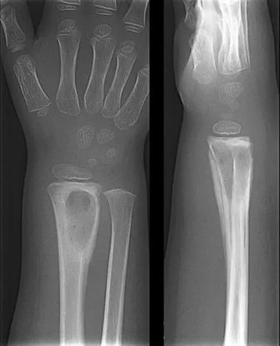 X-ray of pediatric wrist with osteomyelitis