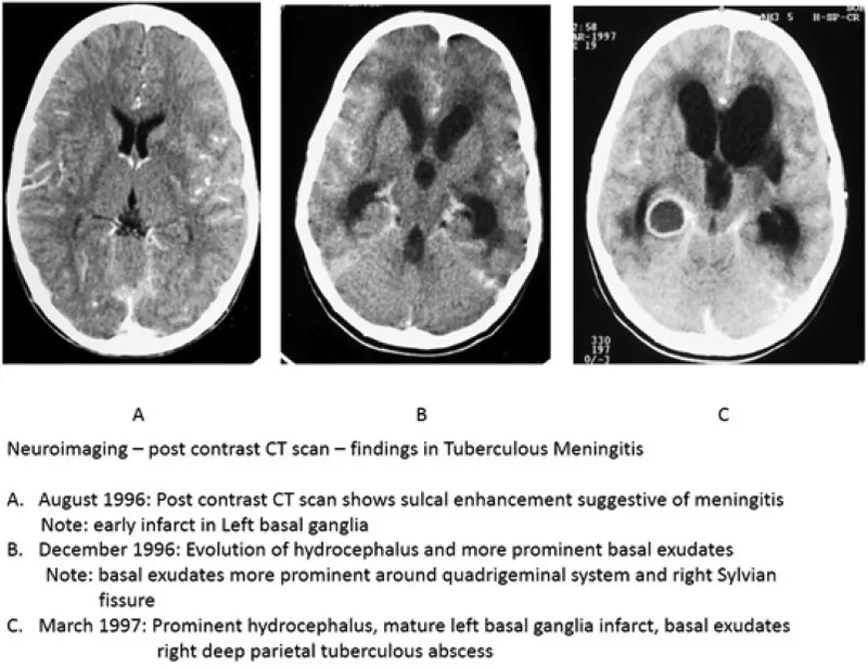 CT scans showing progression of TB meningitis
