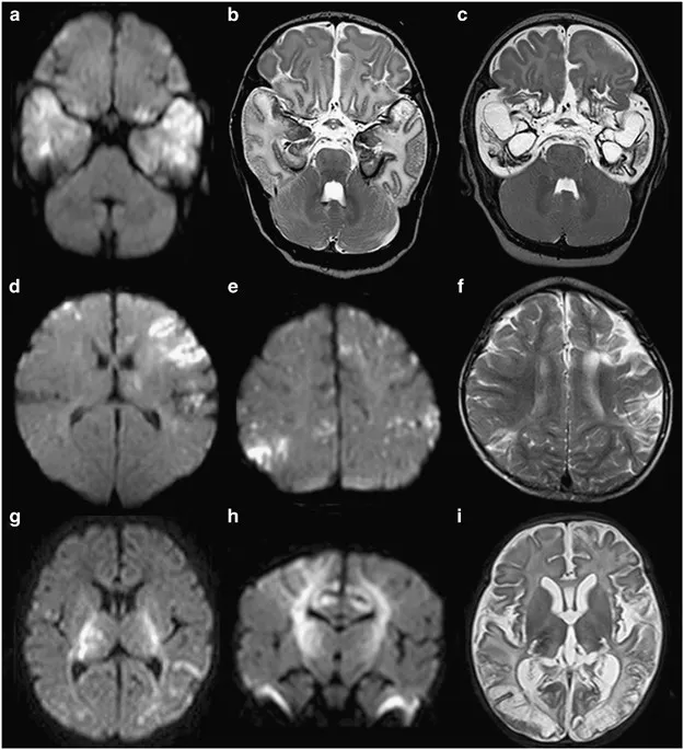 MRI brain: Herpes simplex encephalitis