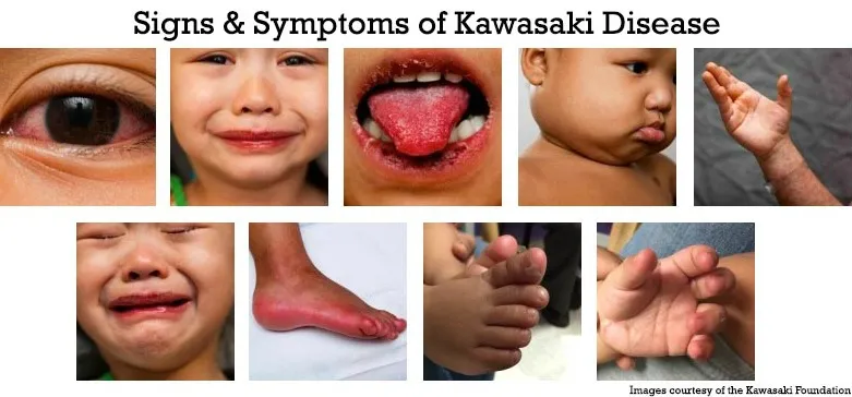 Kawasaki Disease: Clinical Signs Collage