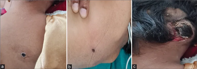 Painless eschar of scrub typhus in different body locations