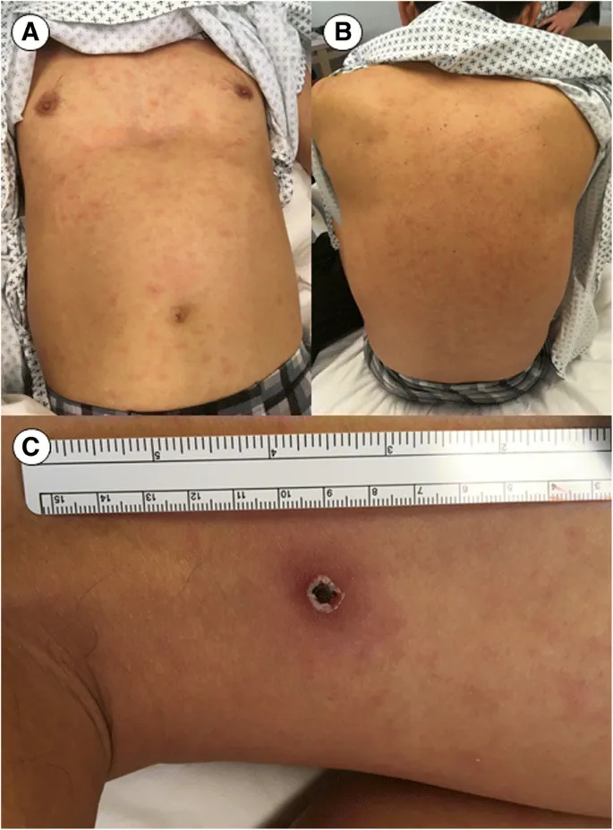 Scrub typhus rash and eschar