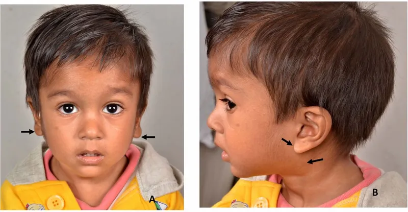 Pediatric HIV: Bilateral Parotid Swelling