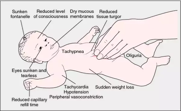 Clinical signs of dehydration in infants