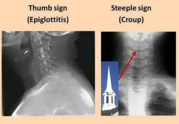 Thumb sign (Epiglottitis) vs. Steeple sign (Croup) X-rays
