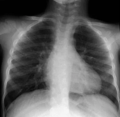 Chest X-ray: Perihilar infiltrates in pediatric pertussis