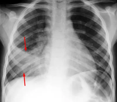 Chest X-ray: Lobar consolidation in pediatric pneumonia