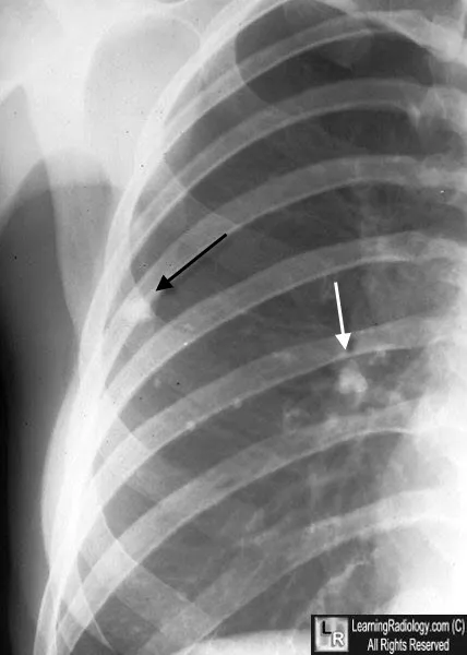Chest X-ray: Ghon and Ranke Complexes in Pediatric TB