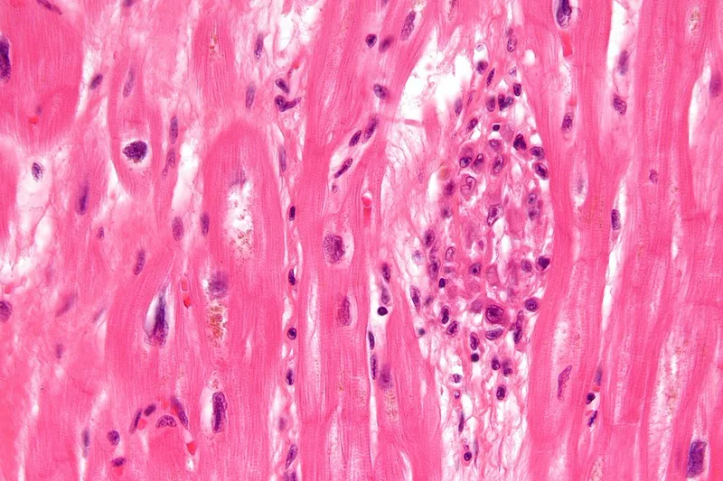 Aschoff body in myocardium (rheumatic fever)