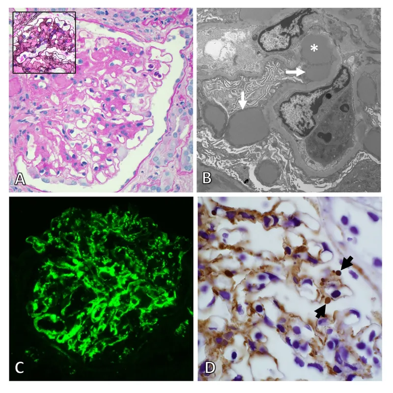 Kidney biopsy in post-streptococcal glomerulonephritis
