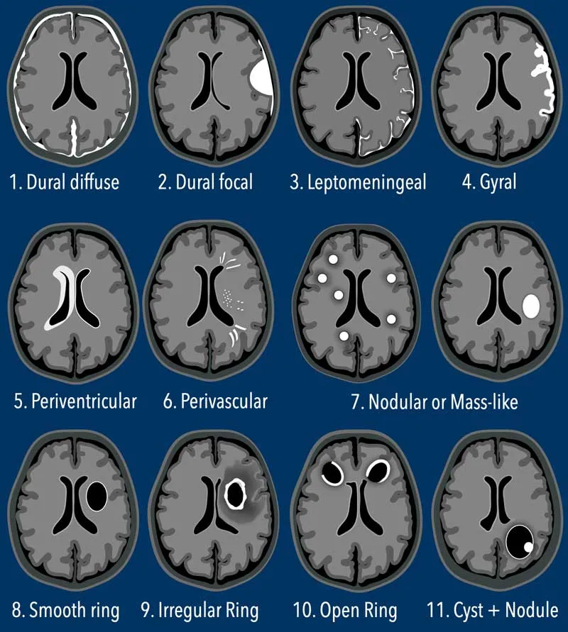 Patterns of meningeal enhancement on MRI