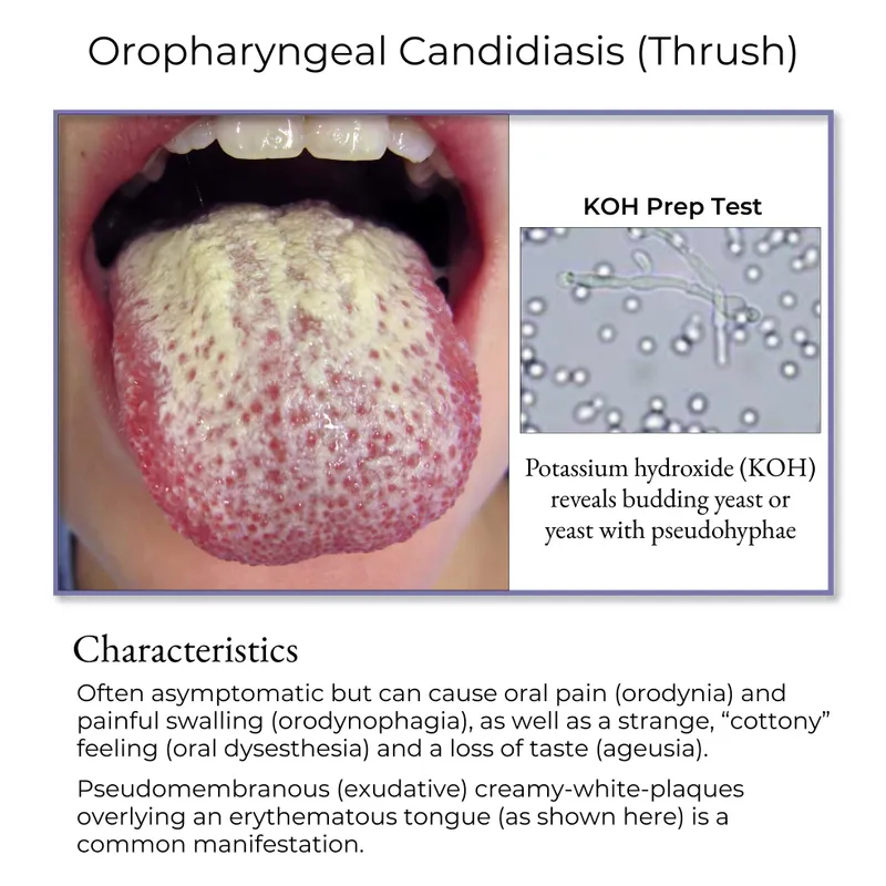 Oral Thrush with KOH Prep