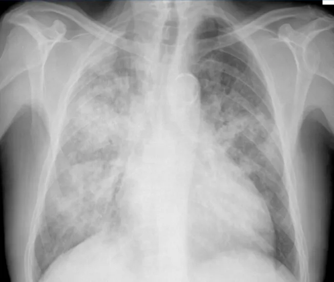 Chest X-ray: Pneumocystis jirovecii Pneumonia