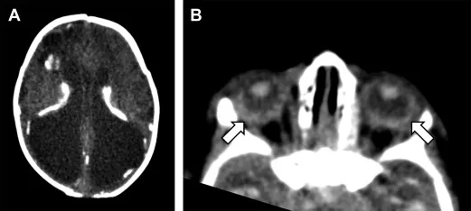 Congenital Toxoplasmosis: Brain Calcifications and Retinitis