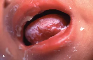 Oral thrush in pediatric HIV