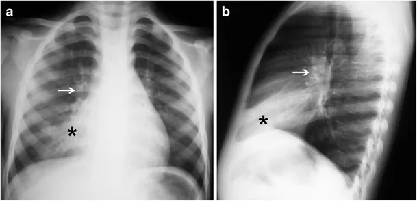 Pediatric chest X-ray showing Ghon complex in primary TB