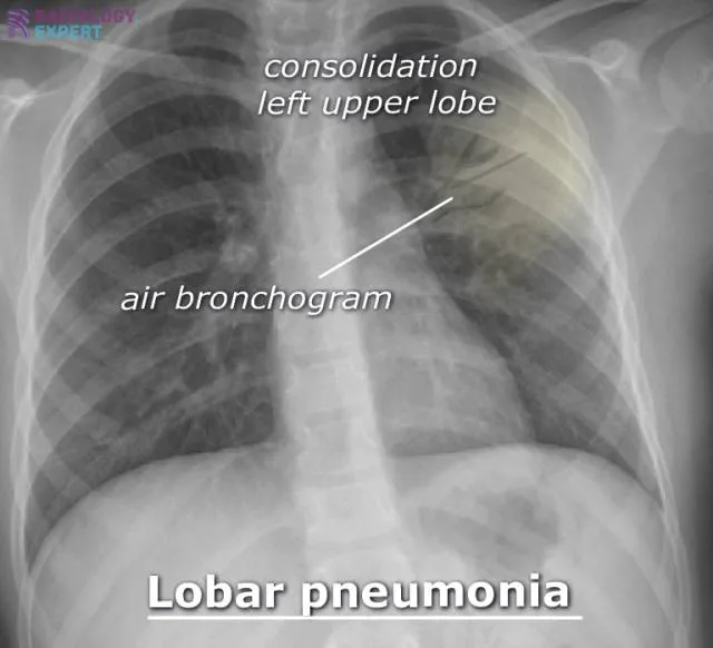Pediatric chest X-ray: Lobar pneumonia, left upper lobe