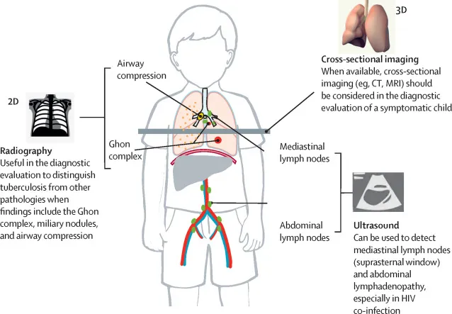 Pediatric TB imaging and diagnosis