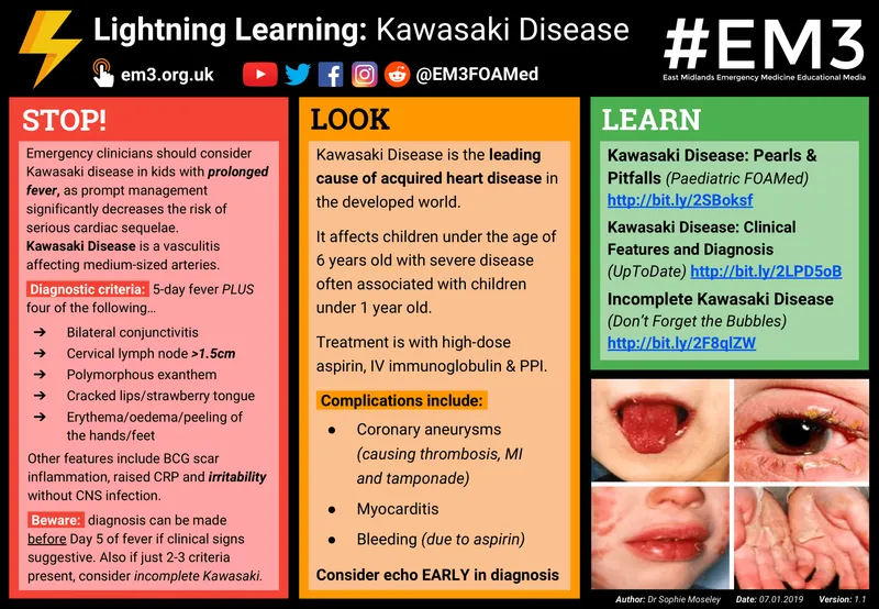 Kawasaki Disease: Clinical Signs Collage