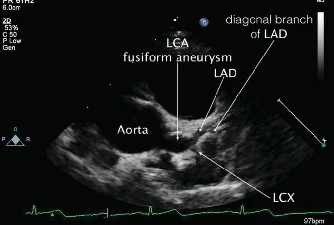 Coronary artery aneurysm in Kawasaki Disease