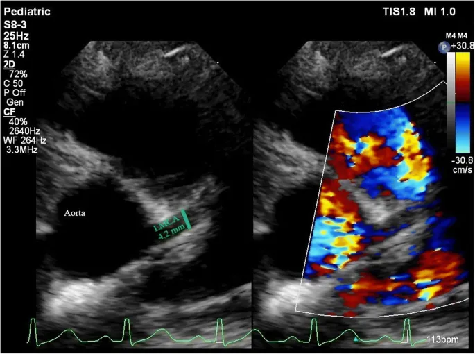 Echocardiogram: Left Main Coronary Artery Aneurysm