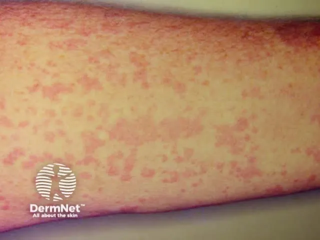 Evanescent salmon-pink rash of Systemic JIA